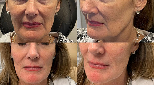ABA pt FIller B&A