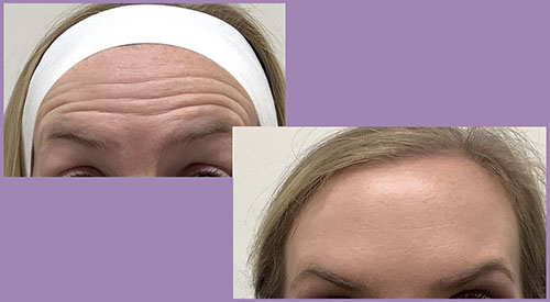 BOTOX B&A