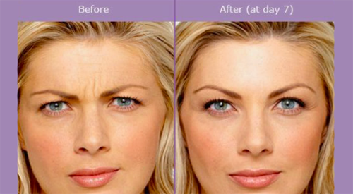 Botox B&A Main one